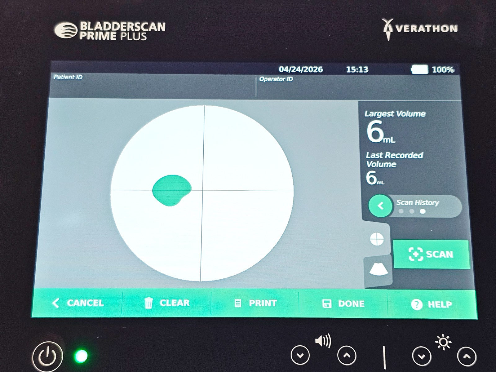 Verathon BladderScan used bladder volume scanner additional angle view