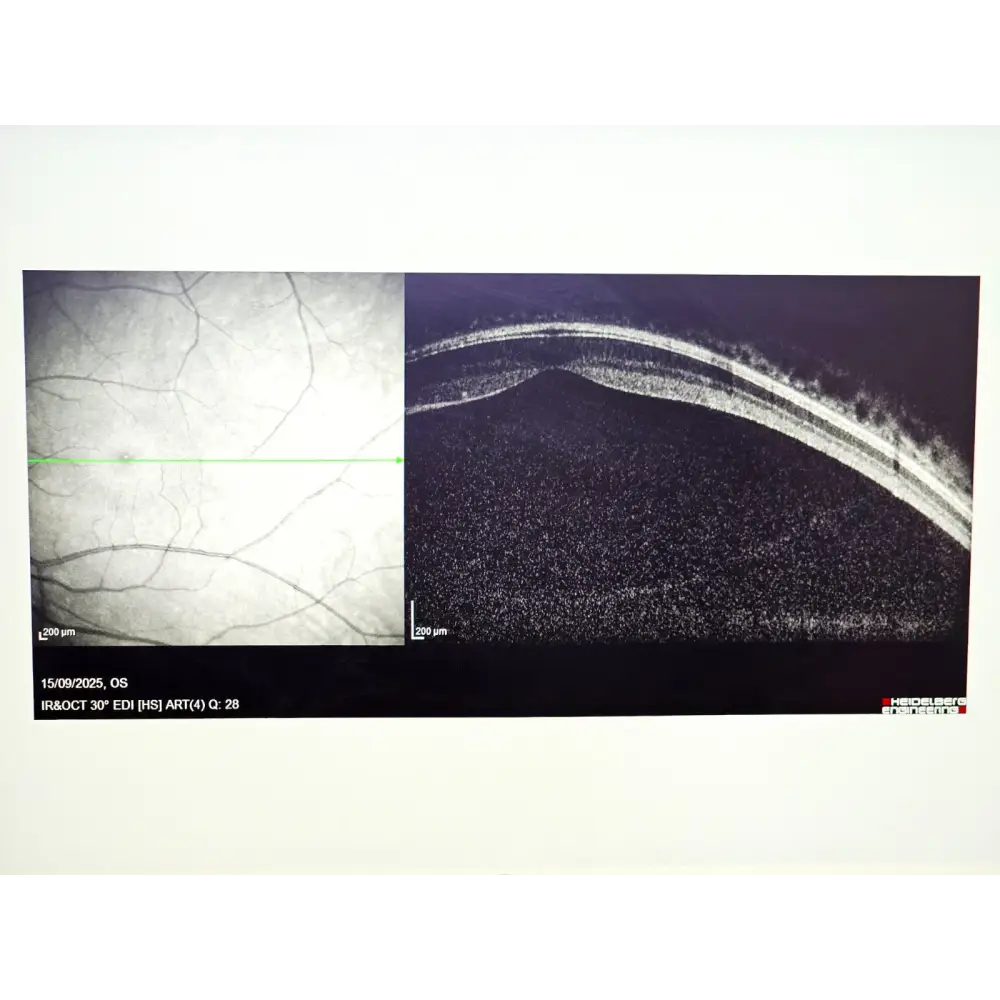 Heidelberg Engineering HRA + OCT Spectralis Imaging System MFD 2012
