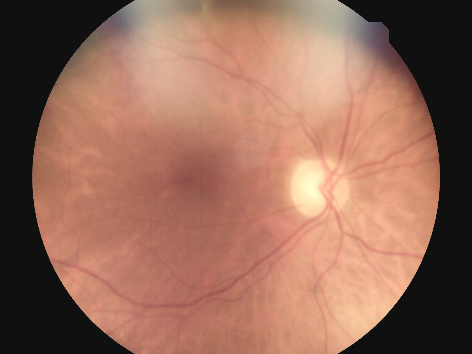 Fundus image captured with the Nidek DS-20 VersaCam showing retinal detail