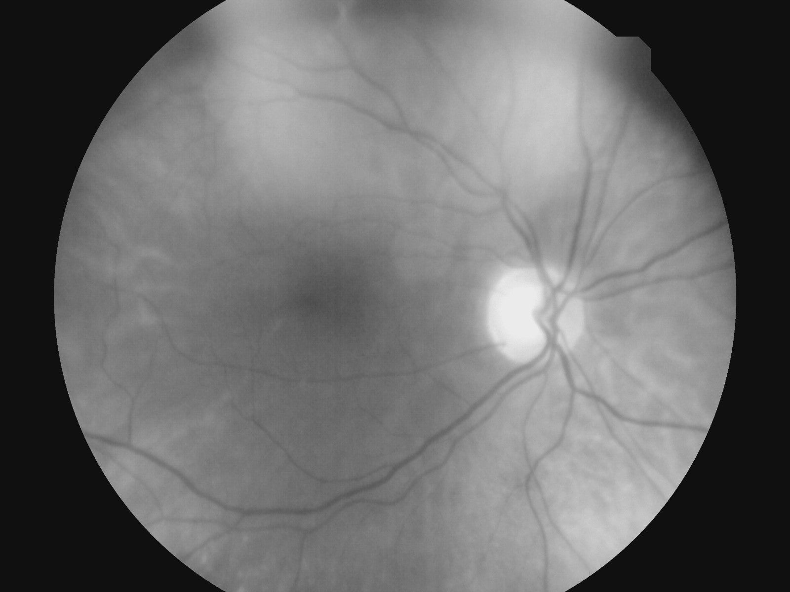 Retinal fundus photograph taken with Nidek DS-20 VersaCam showing optic disc