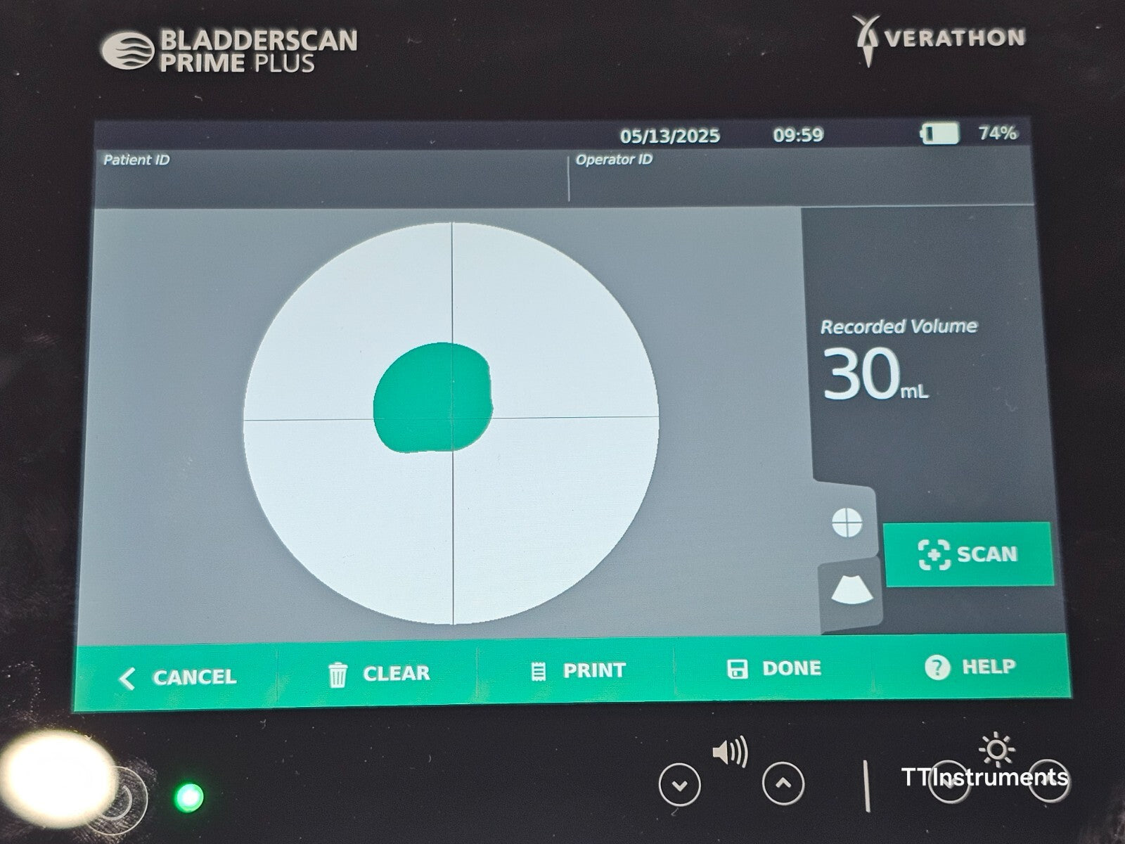 Verathon 0570-0394 BladderScan Prime Plus with Probe and Battery + Charger