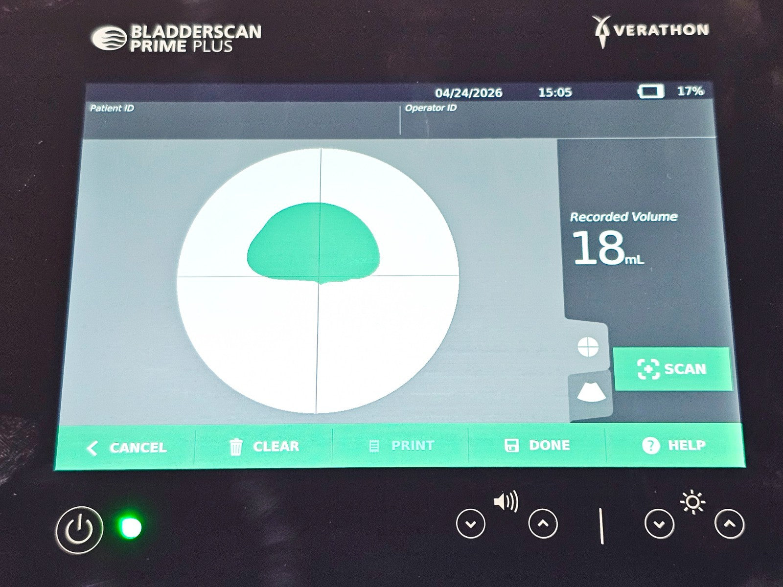 Verathon BladderScan angled view cosmetic condition used medical scanner