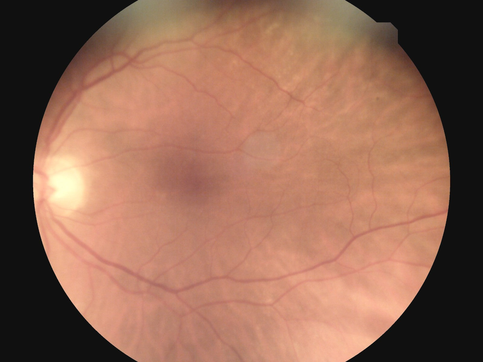 Sample fundus capture from Nidek DS-20 VersaCam demonstrating 45-degree field of view